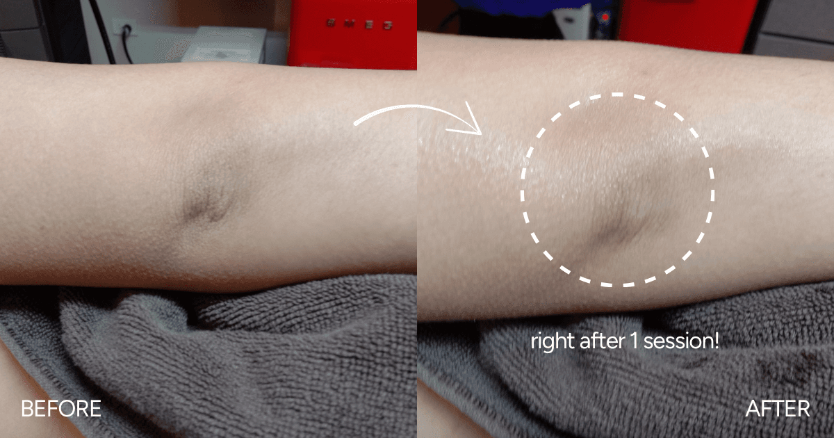 Elbow Whitening VBlush Plus: Brighten Dark Elbows