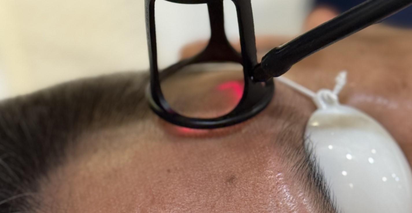 Fractional CO2 Laser + Exosomes Skin Repair Session