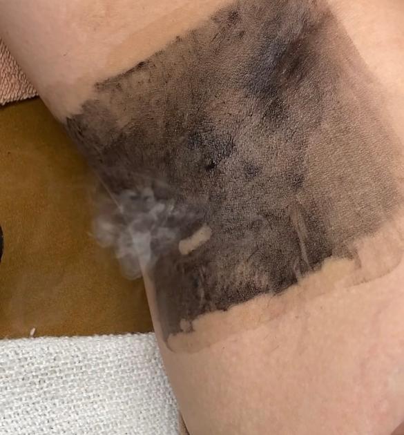 Black Doll Carbon Laser - Underarms, Painless Peel