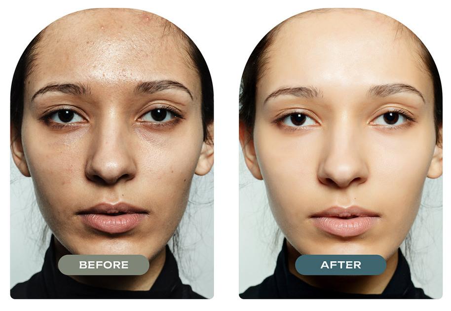 Genius RF Microneedling for Scars & Wrinkles