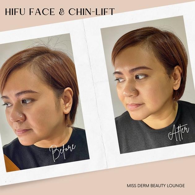 HIFU Face Lift, Firmer Jawline + Smoother Skin