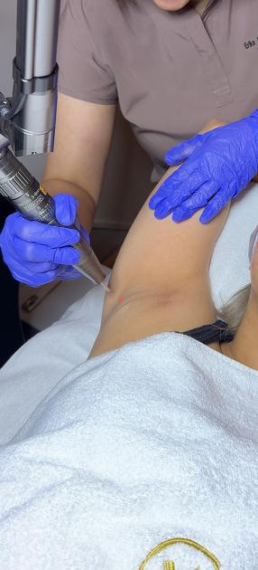 Skinbright Underarm Laser Whitening, 20 to 30 Mins